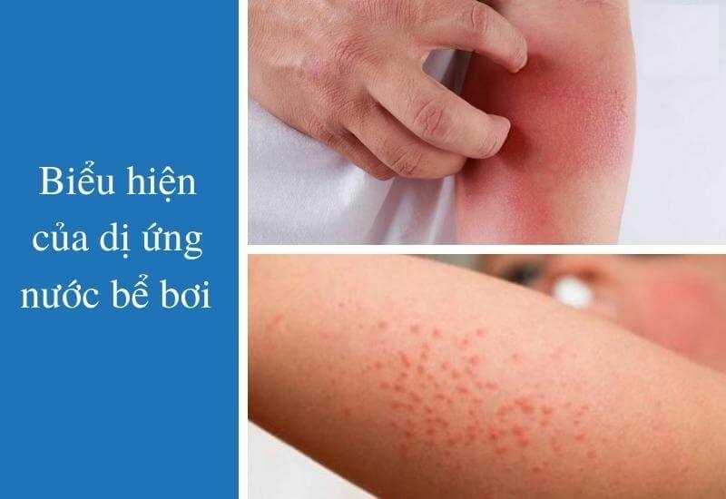 Dấu hiệu dị ứng nước hồ bơi